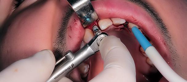 implant straumann mis strauman direkt