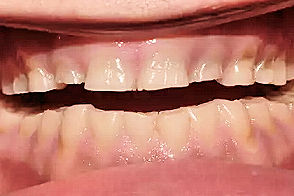 bruksizm bruxism bruksism diş sıxma